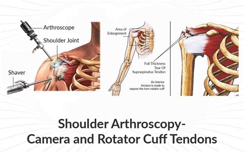 Rotator Cuff Surgery and Recovery : Shoulder Surgery