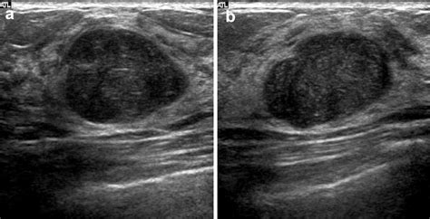 Phyllodes Tumors of the Breast: Ultrasonographic Findings and Diagnostic Performance of ...