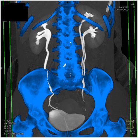 CT Urogram with Duplicated Collecting System on the Left - Kidney Case Studies - CTisus CT Scanning