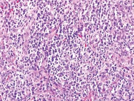 Secondary Syphilis Histology