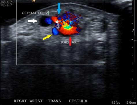 Dialysis Fistula Ultrasound