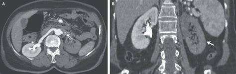 Renal Artery Thrombosis in Essential Thrombocythemia - MEDizzy