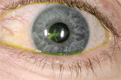 Eye ulcer - Stock Image - C002/4931 - Science Photo Library