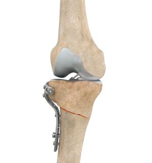 High Tibial Osteotomy Murray, UT | Osteochondritis Dissecans Murray, UT