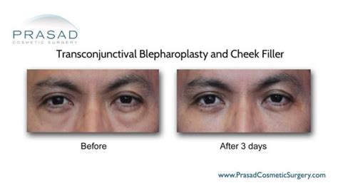 Lower Blepharoplasty Recovery Process | Dr. Prasad Blog