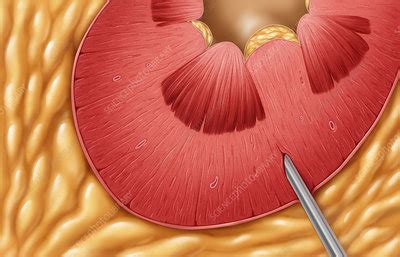 Renal Biopsy - Stock Image - M490/0060 - Science Photo Library