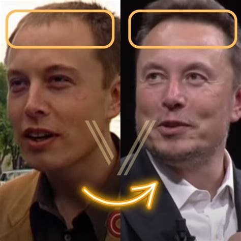 Elon Musk's Hair Transplant: Before and After Transformation