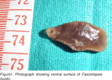 Fasciolopsiasis presenting as intestinal perforation: A case report