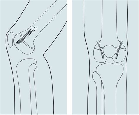 Treatment of Joint Malalignment | Gillette Children's