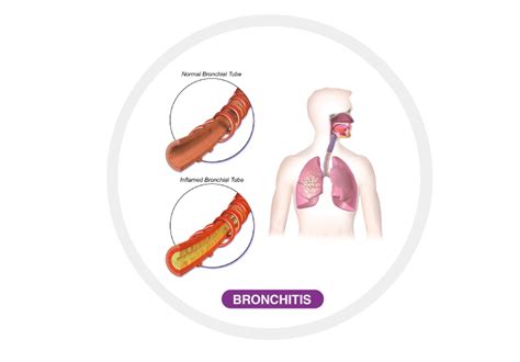 Lung Diseases – Types, Causes, and their Symptoms