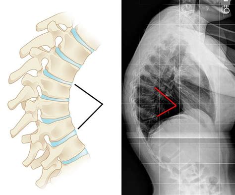 Kyphosis (Roundback) of the Spine - OrthoInfo - AAOS