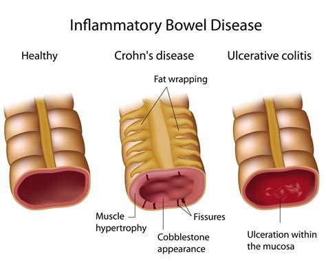 inflammatory bowel disease- crohn's and ulcerative colitis - DSSurgery