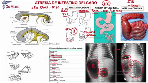 Atresias Intestinales - YouTube