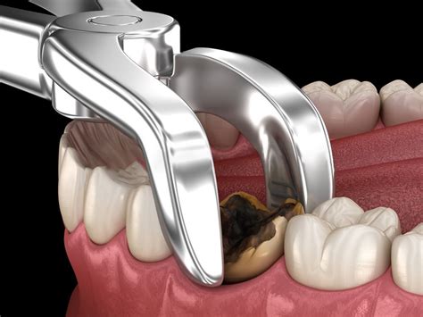 Simple & Surgical Tooth Extraction - Woden Dental