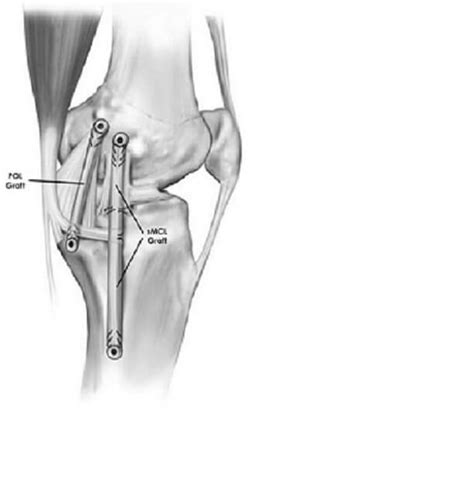 Arthroscopic Knee Surgery Cost In Mumbai | Knee Arthroscopy