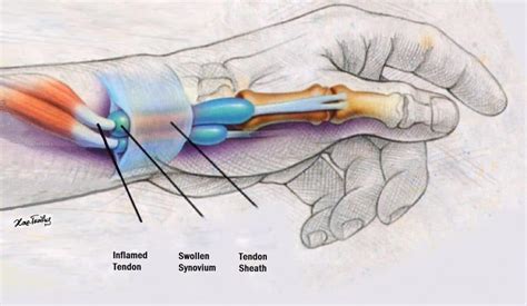 De Quervain tenosynovitis - almostadoctor