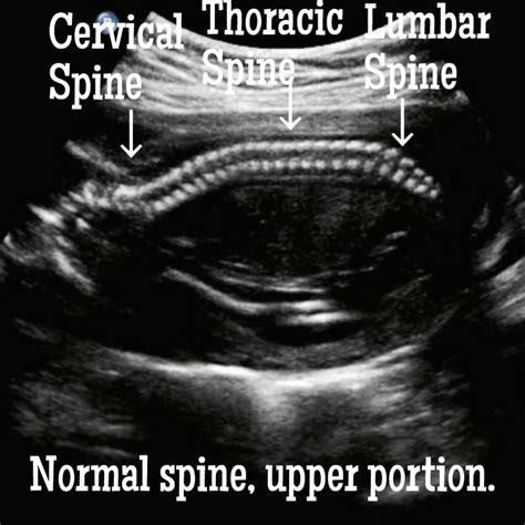 Information about Spina Bifida ultrasound. - Ultrasoundfeminsider