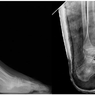 Severe cavovarus deformity treated by Tarsal osteotomy. | Download Scientific Diagram