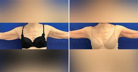 J Plasma Before and After Photos | Manchester Private Hospital