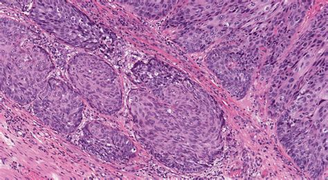 Esophageal Squamous Cell Carcinoma Histology