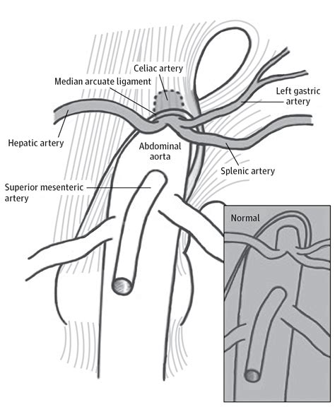 Median Arcuate Ligament Syndrome—Review of This Rare Disease | Clinical Decision Support | JAMA ...