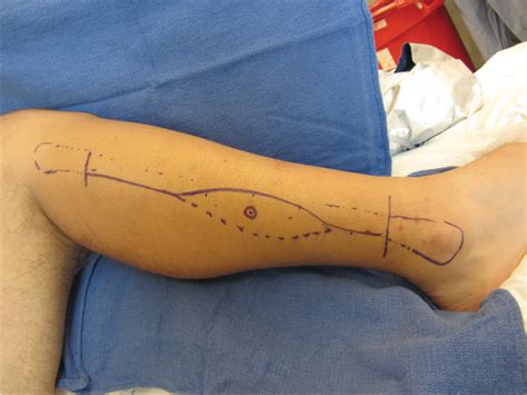 Free Fibular Flap | Musculoskeletal Key