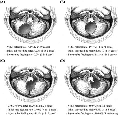 Schematic drawings of four posterior fossa tumor pathologies; the rate... | Download Scientific ...