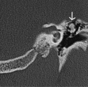 Osteoma of the middle ear | Brazilian Journal of Otorhinolaryngology