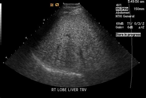Fatty liver ultrasound - wikidoc
