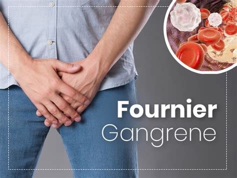 Fournier Gangrene: Causes, Symptoms, Risk factors, Treatment, And Prevention - Boldsky.com