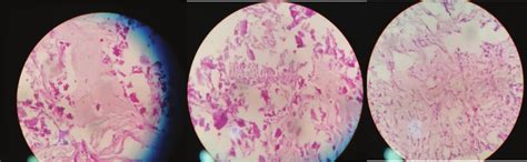 Histopathology specimen of calcified tissue which shows that calcific... | Download Scientific ...