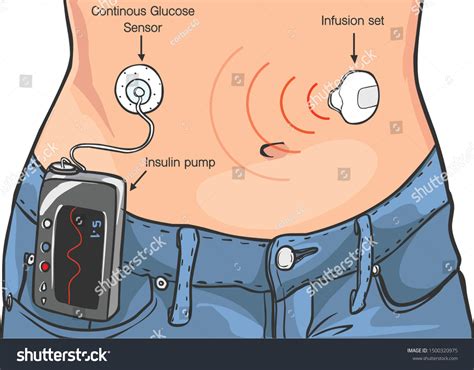 Insulin Pump: Over 377 Royalty-Free Licensable Stock Vectors & Vector ...