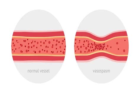 Vasospastic Disorders: Causes, Symptoms, and Prevention - Longmore Clinic