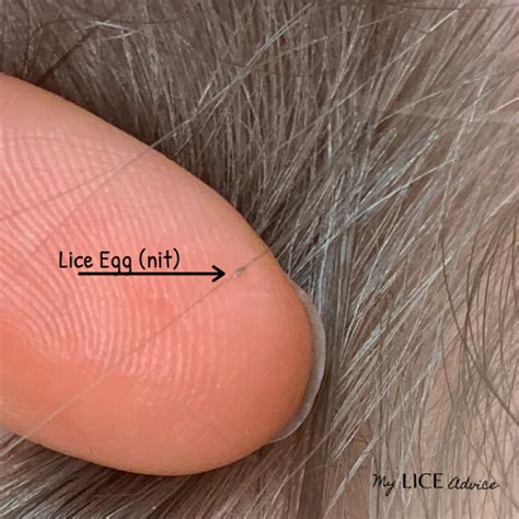 Lice vs Dandruff - 7 Key Differences Between Lice Eggs and Dandruff in 2021 | Lice eggs, Lice vs ...