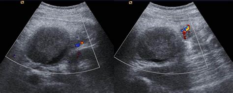 Complicated Mesenteric Cyst | Eurorad