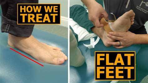 How We Treat Flat Feet | Collapsed Arches | Physical Therapy - YouTube