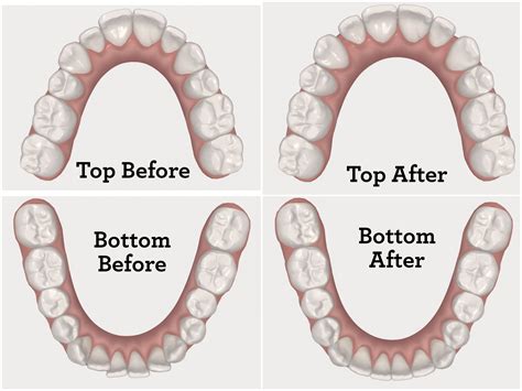 Inspiralized: My Invisalign Experience: Correcting a Crossbite and Crowding