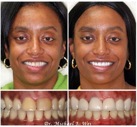 Cerinate Lumineers in Manhattan NYC - Transform Your Smile with a ...