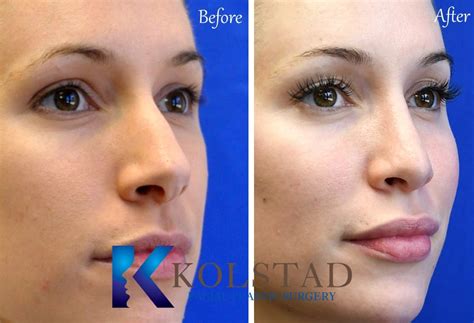 Wide Bridge Nose Job Before & After Gallery 1 | Dr. Kolstad - San Diego ...