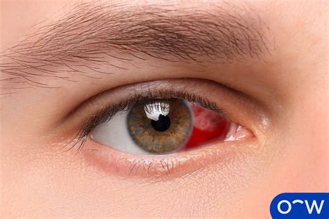 Hyphema Subconjunctival Hemorrhage