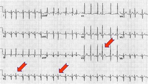 Interprete Fascinante Tienda extrasistole auricular my ekg plan de ...