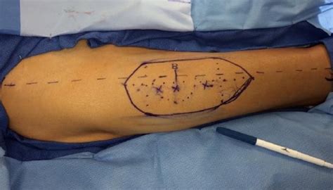 5.16: Anterolateral Thigh (ALT) Free Flap in Head and Neck Reconstruction - Medicine LibreTexts