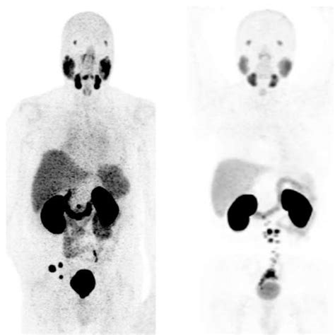 PSMA PET Scan, Preparation, Procedure, and the Requirements