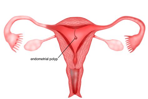 Chapter 6 – Endometrial polyps – Melaka Fertility