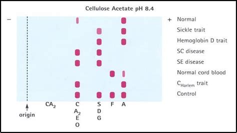 Hemoglobin gel electrophoresis patterns Medical Laboratory Scientist ...