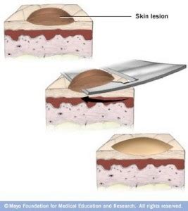 Solving the Puzzle - Excisional vs Shave Biopsy - Miller Family ...