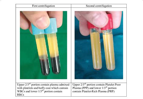 Preparation of autologous platelet rich plasma injection. | Download ...