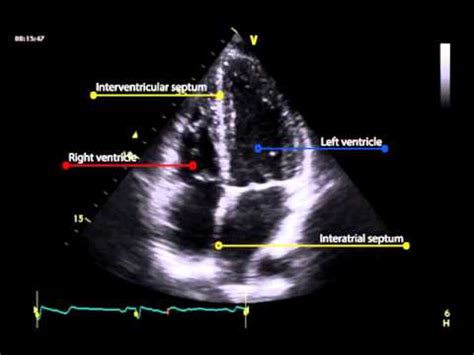 8A. Apical four chamber view (normal) - YouTube