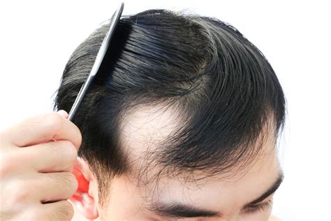 Why Men are Balding in Their 20s - Vargas Face and Skin Center