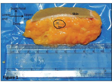 Subcutaneous Fat Surgery